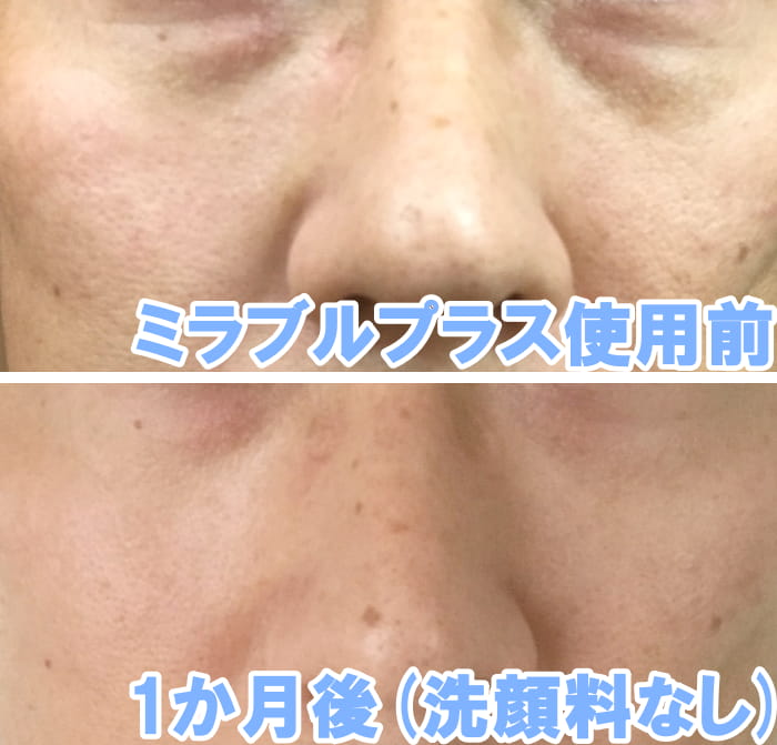 ミラブルプラス 毛穴のビフォーアフター