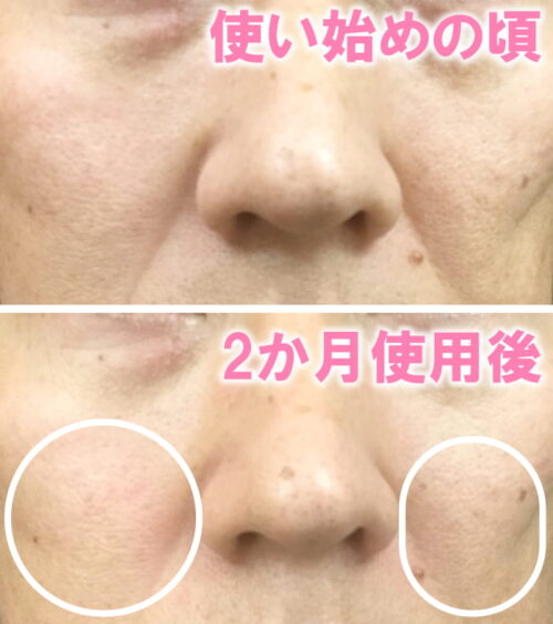 ミラブルキティ使用前と使用後